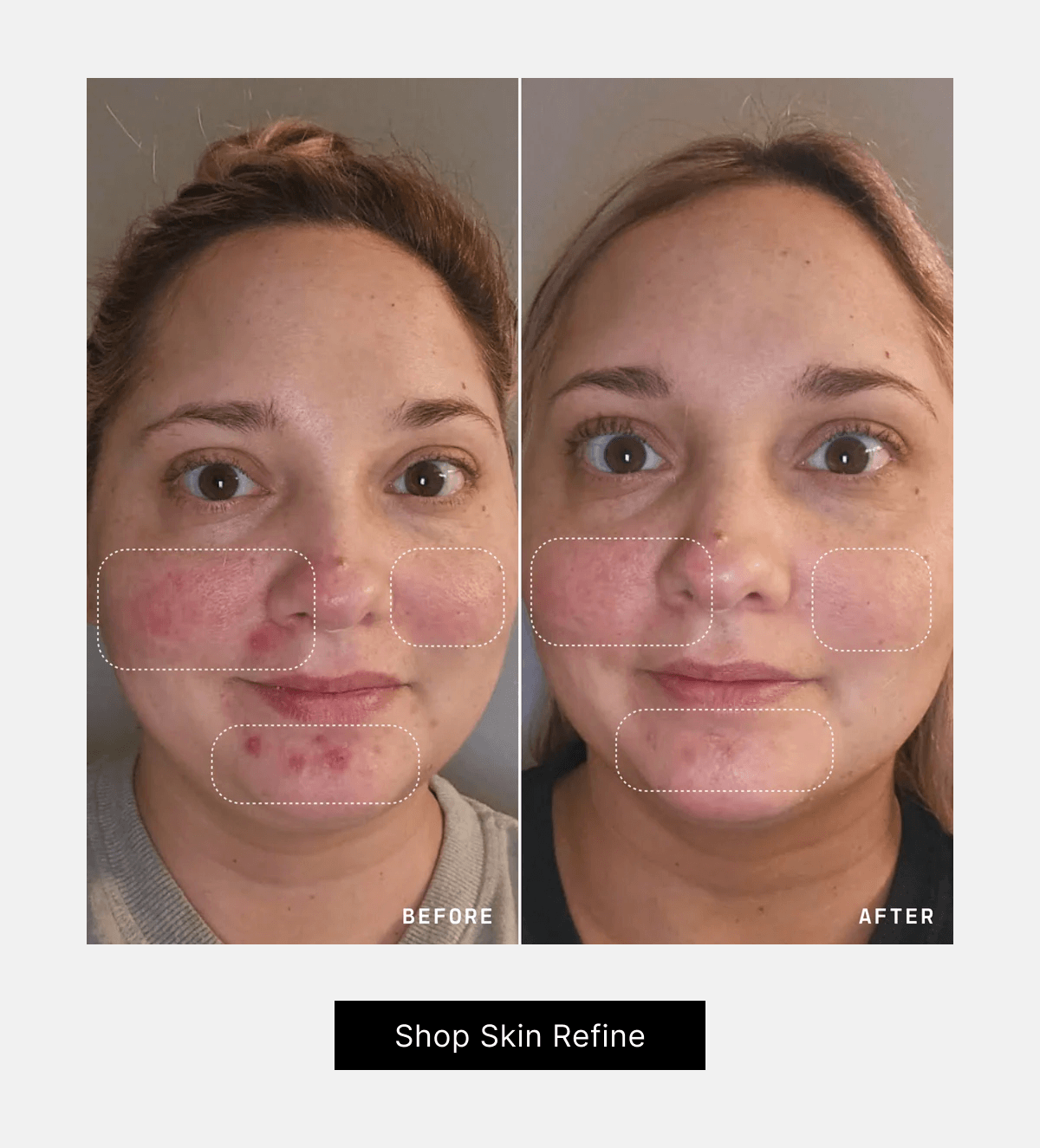 Before and after using Skin Refine. Shop Skin Refine.